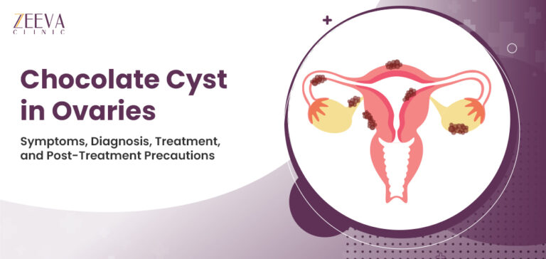 Chocolate Cyst in Ovaries- Symptoms, Diagnosis, Treatment, and Post-Treatment Precautions